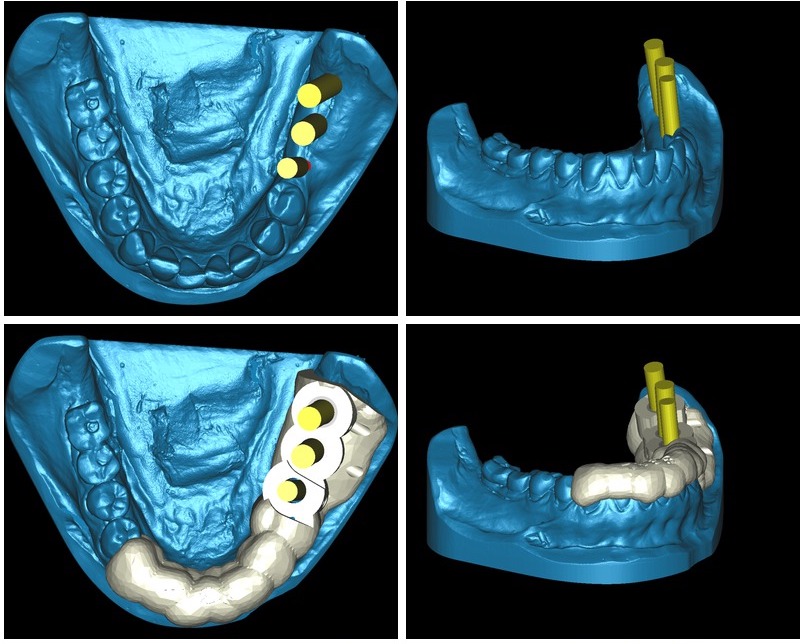Mediante un software dental se planifica la intervención previamente / Clínica Dental Barrachina 