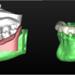Es posible combinar los datos del hueso obtenido en el escáner 3D CBCT