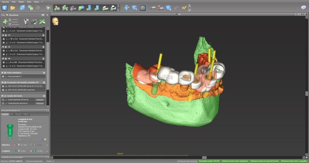 Planificación en 3D de los implantes dentales con cirugía guiada