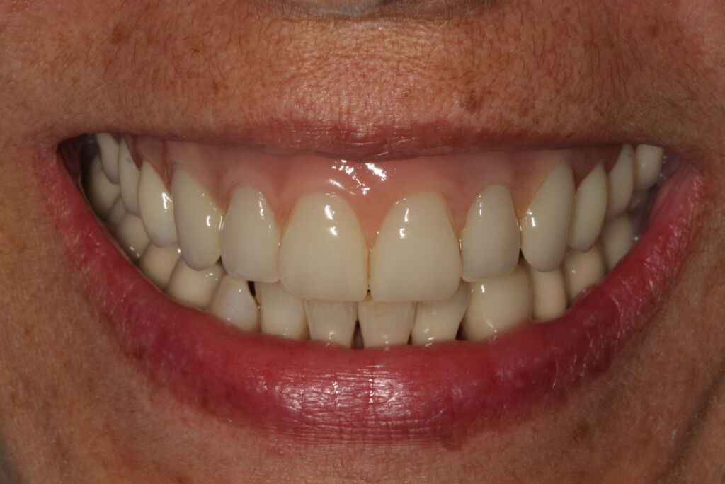 Prótesis removible sobre implantes con dientes de composite